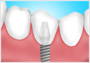 インプラント