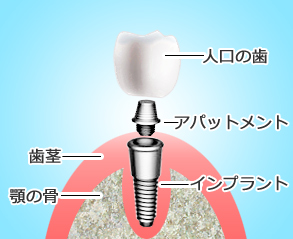 インプラント